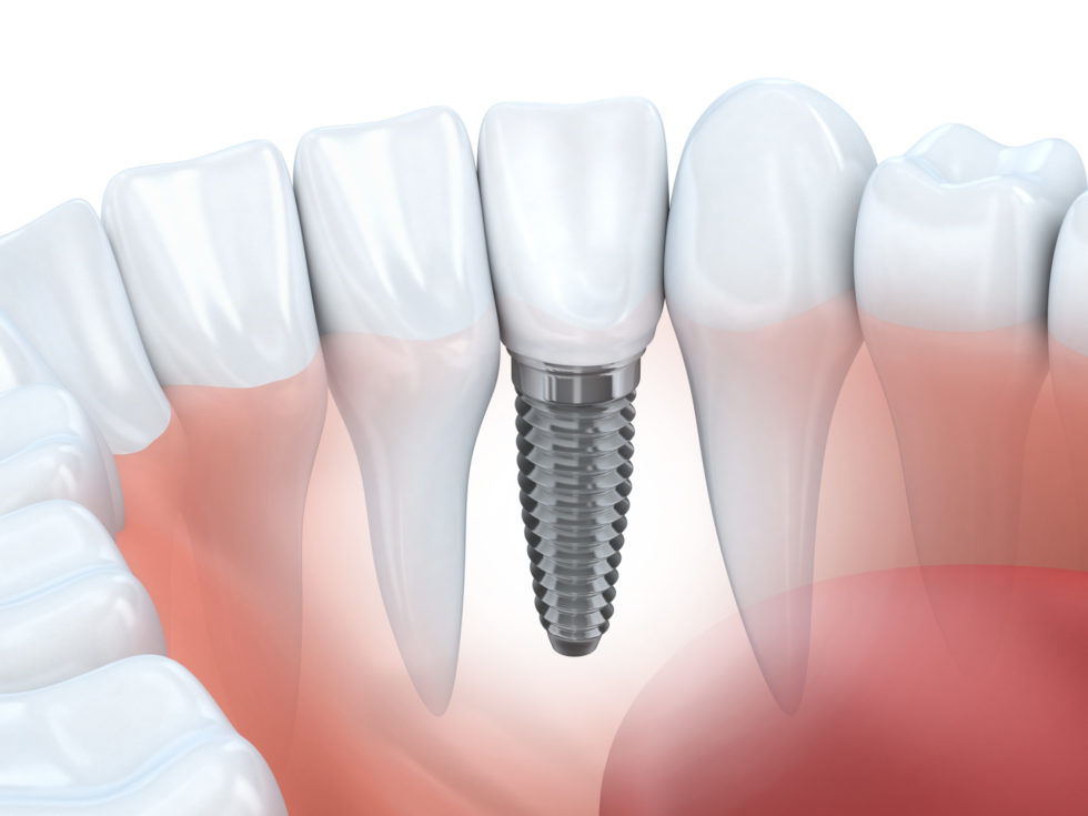 Comprendre les principaux facteurs d’échec des implants dentaires